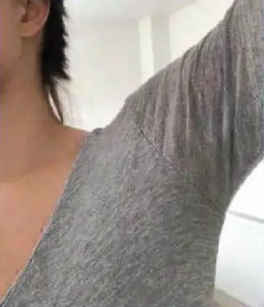 After miraDry: the same gray shirt, dry under the arm