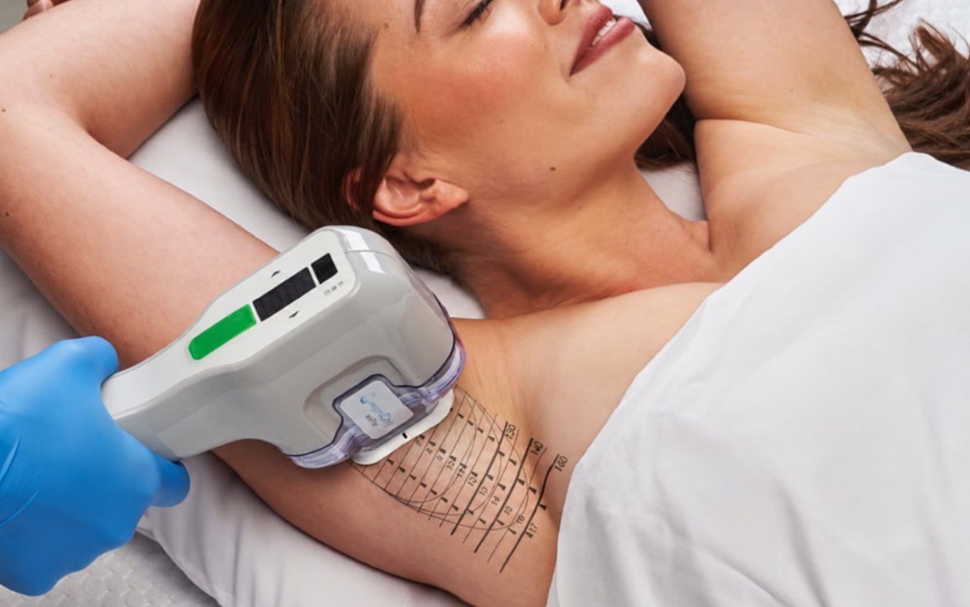A miraDry underarm treatment
