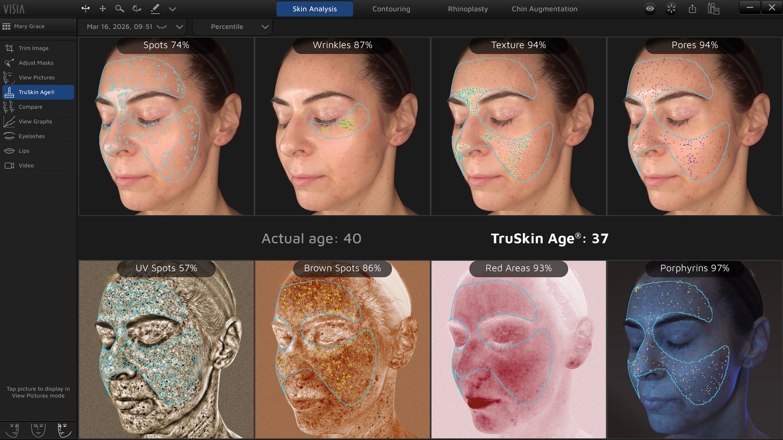 VISIA skin analysis results showing spots, wrinkles, texture, pores and other measures